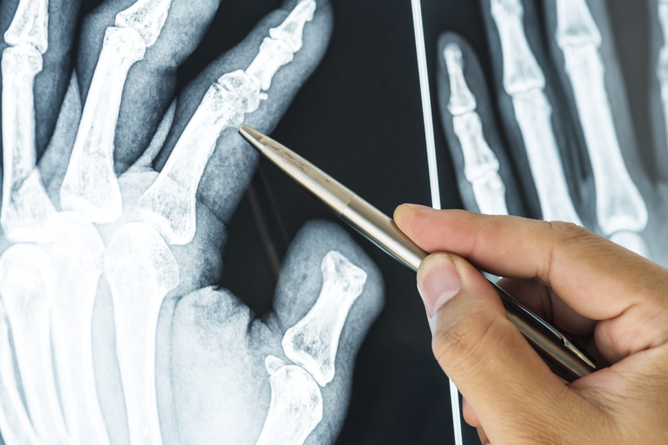 Hand holding a pencil pointing to an x-ray of hand with arthritis