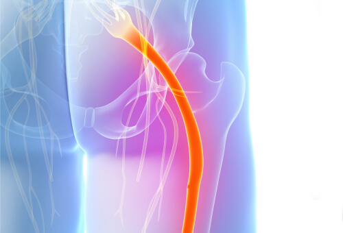 Sciatic Nerve-X Ray Image