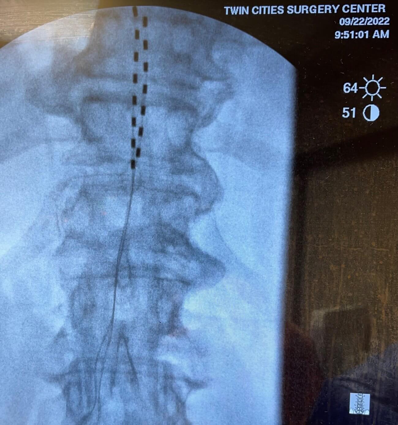 X-ray of spinal cord stimulator leads being implanted on patient spine