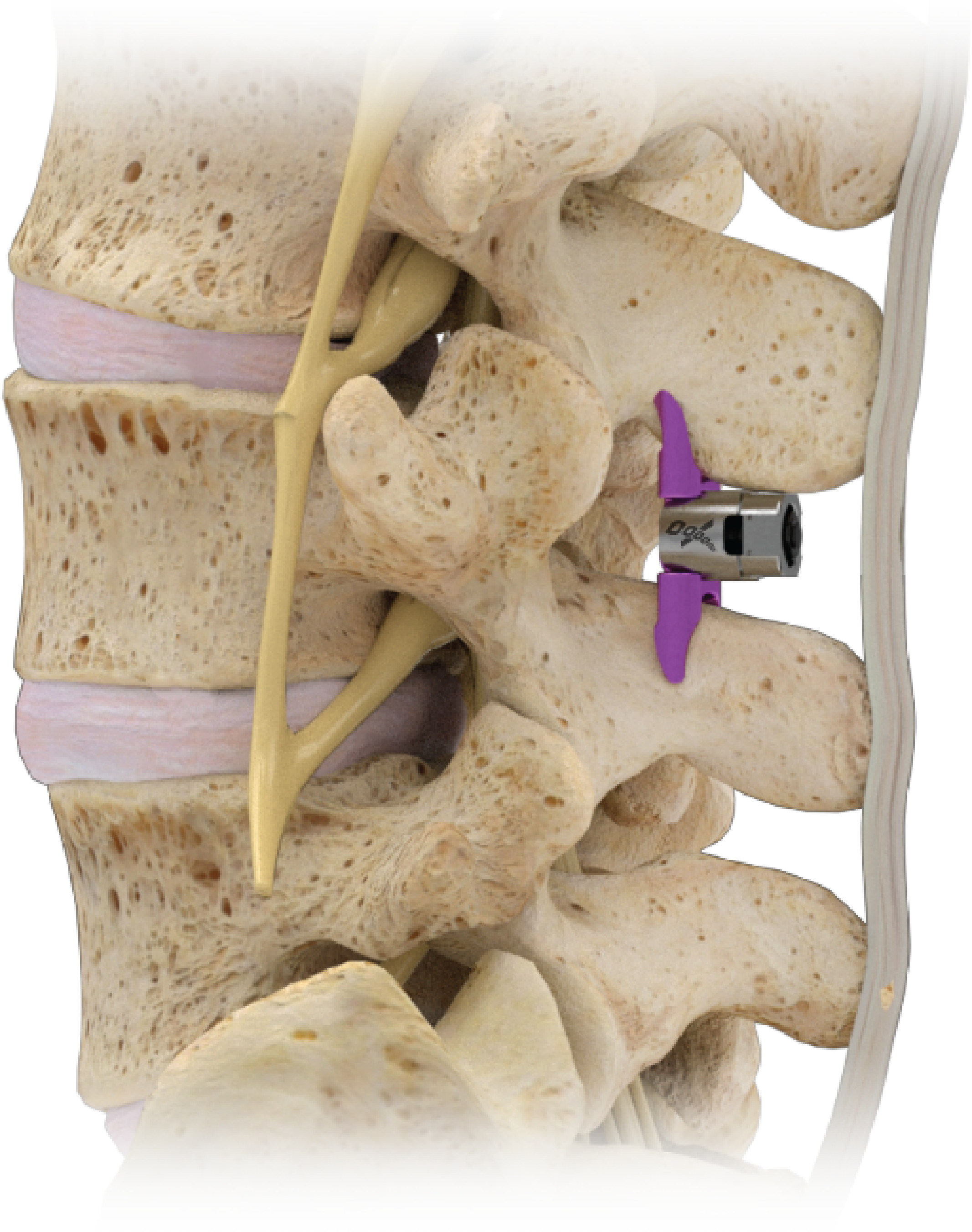 Image of Implanted Vertiflex Spacer